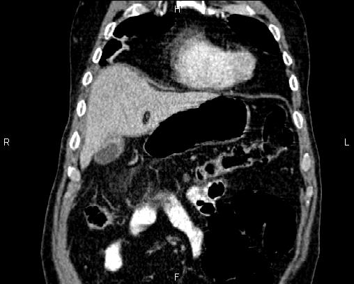 Acute pancreatitis (Radiopaedia 85146-100701 Coronal C+ portal venous phase 13).jpg