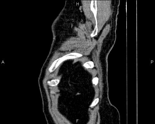 Acute pancreatitis (Radiopaedia 85146-100701 Sagittal C+ portal venous phase 94).jpg