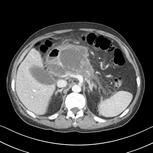 Acute pancreatitis and walled-off necrosis (Radiopaedia 29888-30404 Coronal C+ portal venous phase 1).jpg