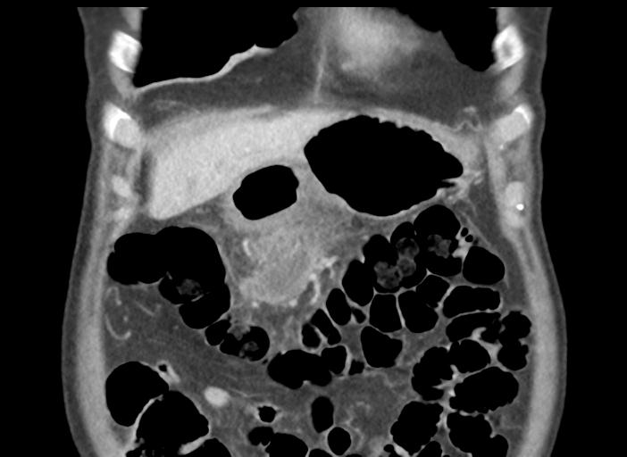 File:Acute pancreatitis and walled-off necrosis (Radiopaedia 29888-30404 Coronal C+ portal venous phase 12).jpg