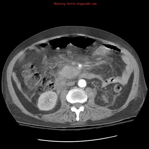 Acute pancreatitis with incidental pancreatic lipoma (Radiopaedia 10190-10730 Axial C+ arterial phase 52).jpg