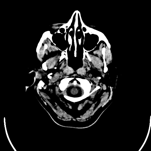 File:Acute pontine infarct from vertebral artery dissection (Radiopaedia 34111-35369 Axial non-contrast 1).png