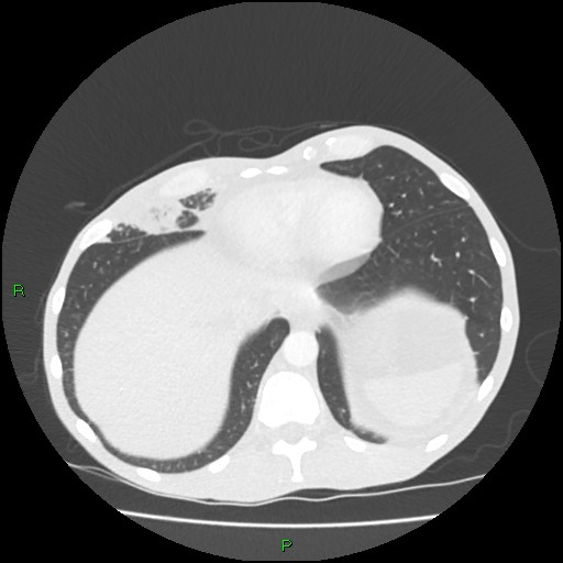 Acute right lung abscess (Radiopaedia 34806-36258 Axial lung window 156).jpg