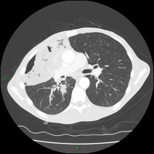 Acute right lung abscess (Radiopaedia 34806-36258 Axial lung window 86).jpg
