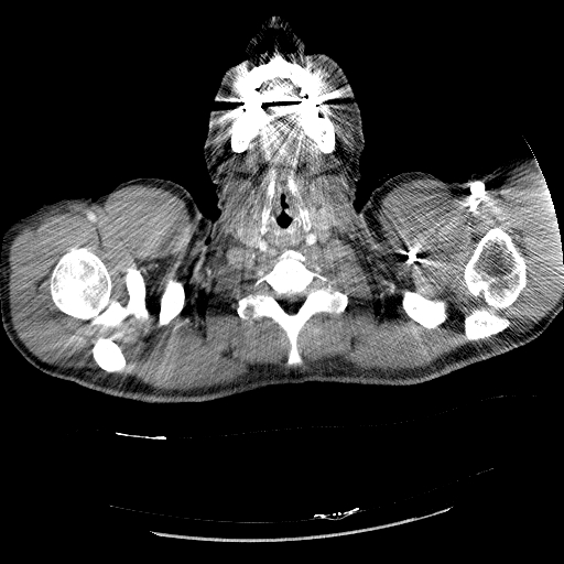 File:Acute segmental pulmonary emboli and pulmonary infarction (Radiopaedia 62264-70444 Axial C+ CTPA 1).jpg