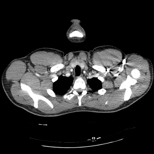 Acute segmental pulmonary emboli and pulmonary infarction (Radiopaedia 62264-70444 Axial C+ CTPA 15).jpg