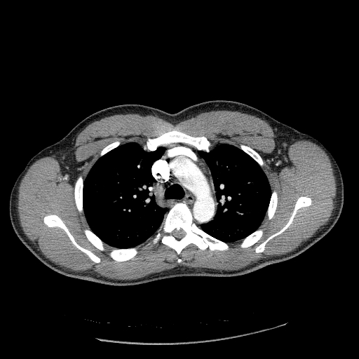 Acute segmental pulmonary emboli and pulmonary infarction (Radiopaedia 62264-70444 Axial C+ CTPA 39).jpg