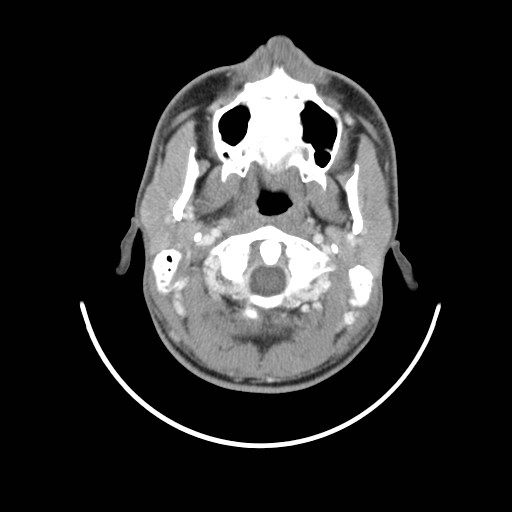 File:Acute submandibular sialadenitis secondary to ductal stone (Radiopaedia 27999-28267 Axial C+ delayed 12).jpg