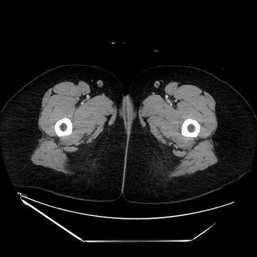 File:Acute uncomplicated appendicitis (Radiopaedia 73704-84499 Axial C+ portal venous phase 187).jpg