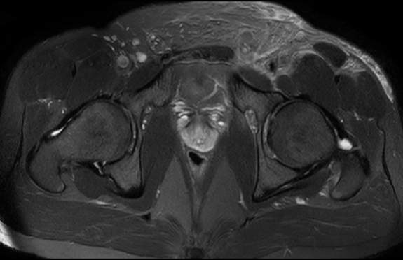 File:Adductor longus tear with retraction (Radiopaedia 56424-63103 Axial T2 fat sat 16).jpg