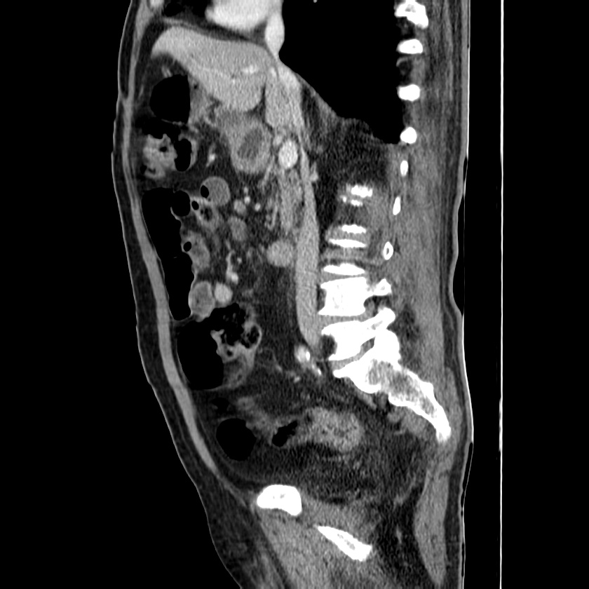 Adenocarcinoma of colon with entero-colic fistula (Radiopaedia 22832-22852 Sagittal C+ portal venous phase 28).jpg