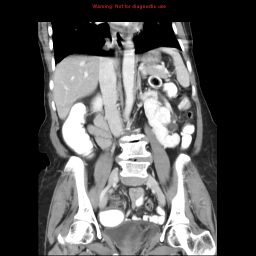 File:Adenocarcinoma of the colon (Radiopaedia 8191-9039 Coronal liver window 26).jpg