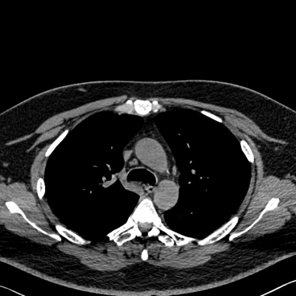 Adenoid cystic carcinoma of the trachea (Radiopaedia 49042-54137 Axial non-contrast 112).jpg