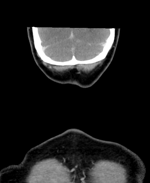 Adenoid cystic tumor of palate (Radiopaedia 46980-51518 Coronal C+ delayed 62).png