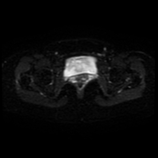Adenoma malignum of cervix (Radiopaedia 66441-75705 Axial DWI 18).jpg