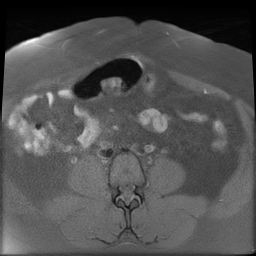 File:Adenomyosis within a didelphys uterus (Radiopaedia 70175-80215 Axial T1 fat sat 8).jpg