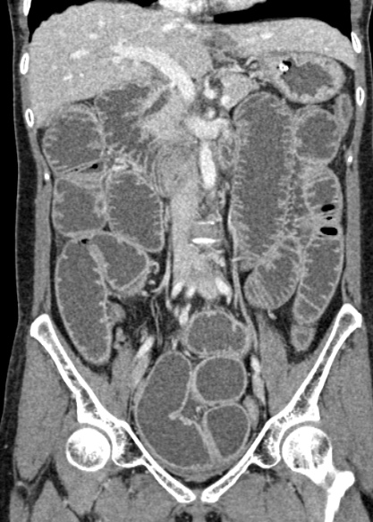 Adhesional small bowel obstruction (Radiopaedia 48397-53305 Coronal C+ portal venous phase 168).jpg