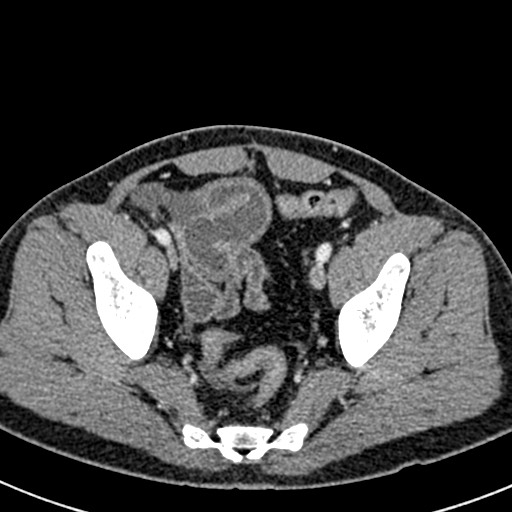 Adhesional small bowel obstruction (Radiopaedia 58900-66131 Axial C+ portal venous phase 46).jpg
