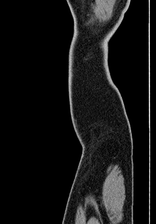 Adhesional small bowel obstruction (Radiopaedia 58900-66131 Sagittal C+ portal venous phase 250).jpg