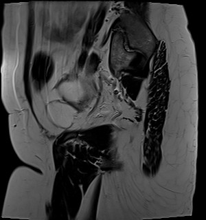 File:Adnexal multilocular cyst (O-RADS US 3- O-RADS MRI 3) (Radiopaedia 87426-103754 Sagittal T2 22).jpg