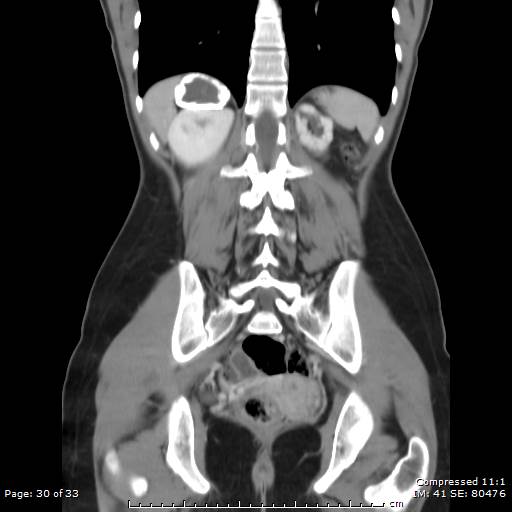 File:Adrenal calcification (Radiopaedia 55755-62314 Coronal C+ portal venous phase 30).jpg
