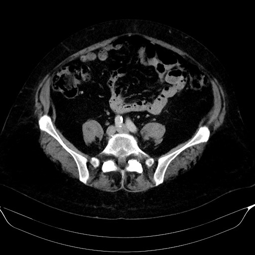Adrenal cortical carcinoma (Radiopaedia 64017-72769 Axial C+ portal venous phase 49).jpg