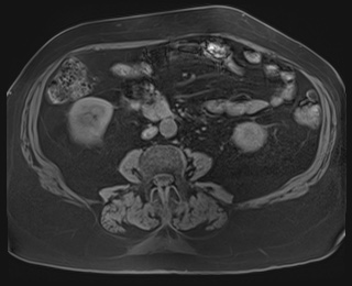 Adrenal cortical carcinoma (Radiopaedia 64017-72770 Axial T1 fat sat 58).jpg