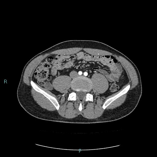 File:Adrenal cystic lymphangioma (Radiopaedia 83161-97534 Axial C+ arterial phase 61).jpg