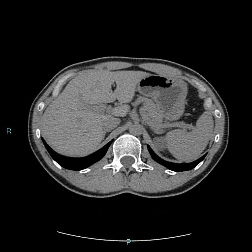 Adrenal cystic lymphangioma (Radiopaedia 83161-97534 Axial non-contrast 27).jpg