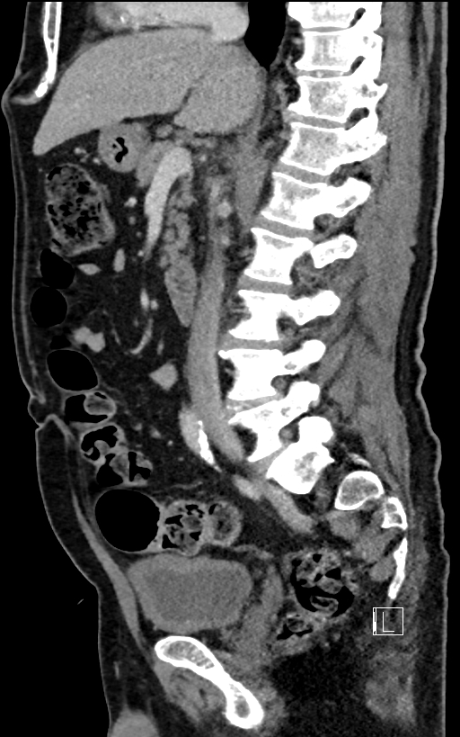 Adrenal lymphoma (Radiopaedia 73730-84529 Sagittal C+ portal venous phase 53).jpg