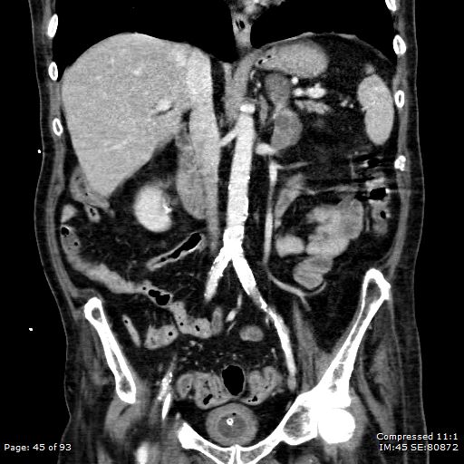 Adrenal metastasis (Radiopaedia 78425-91079 Sagittal C+ portal venous phase 32).jpg
