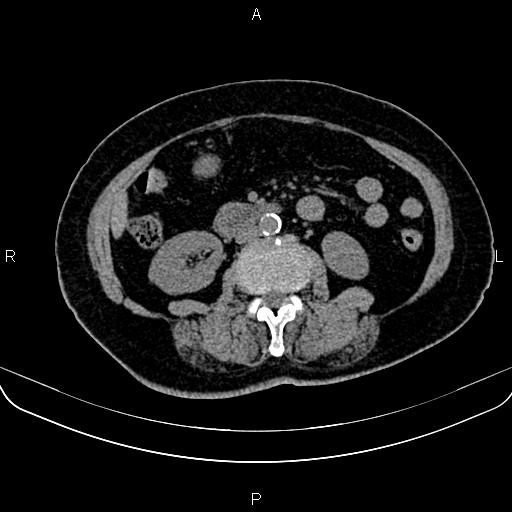 Adrenal myelolipoma (Radiopaedia 82742-96986 Axial non-contrast 80).jpg