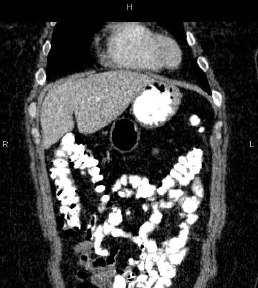 Adrenal myelolipoma (Radiopaedia 84319-99617 Coronal renal cortical phase 15).jpg
