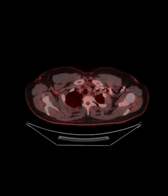 Adrenocortical carcinoma (Radiopaedia 80134-93440 ِAxial 89).jpg
