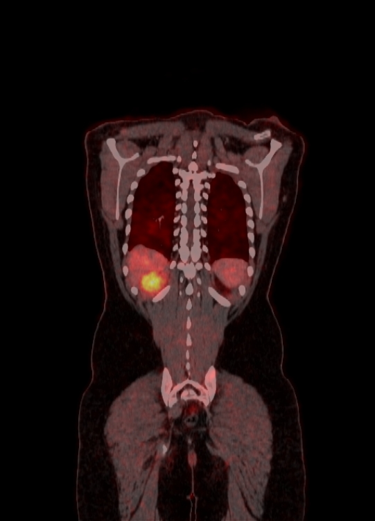 Adrenocortical carcinoma (Radiopaedia 80134-93440 Coronal 158).jpg