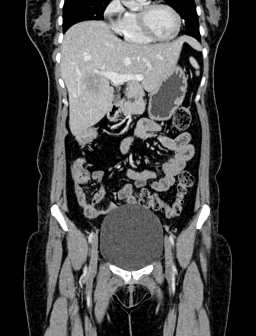 Adrenocortical carcinoma (Radiopaedia 87281-103569 Coronal C+ portal venous phase 3).jpg