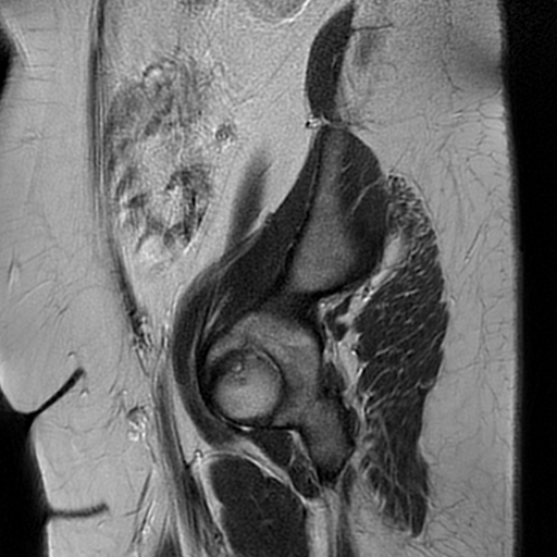 File:Adult granulosa cell tumor of the ovary (Radiopaedia 64991-73953 Sagittal T2 4).jpg
