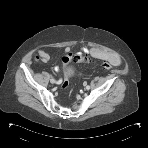 Adult ileal intussusception with secondary obstruction (Radiopaedia 30395-31051 Axial C+ portal venous phase 62).jpg
