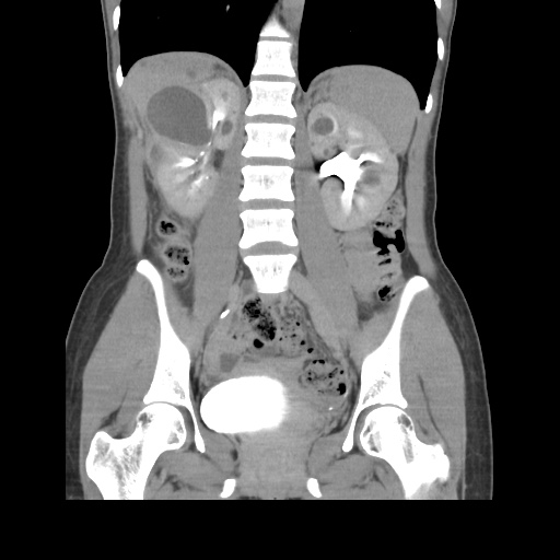 File:Adult polycystic kidney disease (Radiopaedia 48845-53876 Coronal renal excretory phase 26).jpg