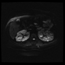 Adult polycystic kidney disease (Radiopaedia 59075-66365 Axial DWI 22).jpg