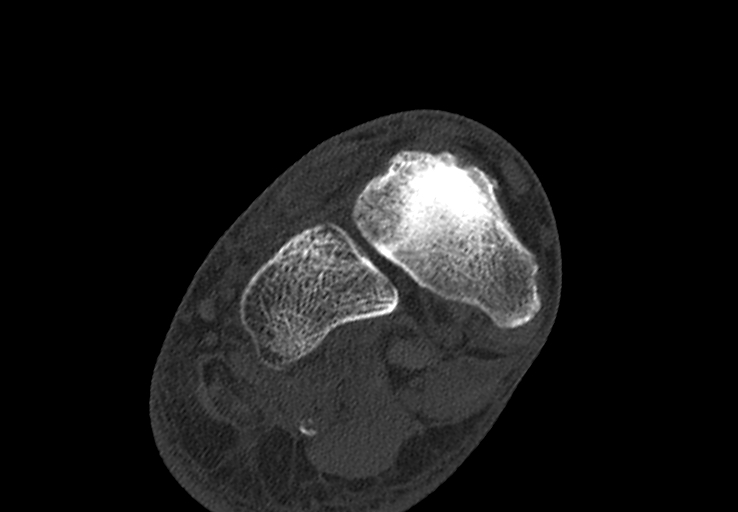 Advanced osteomyelitis due to open metatarsal fracture (Radiopaedia 83891-99095 Axial bone window 18).jpg