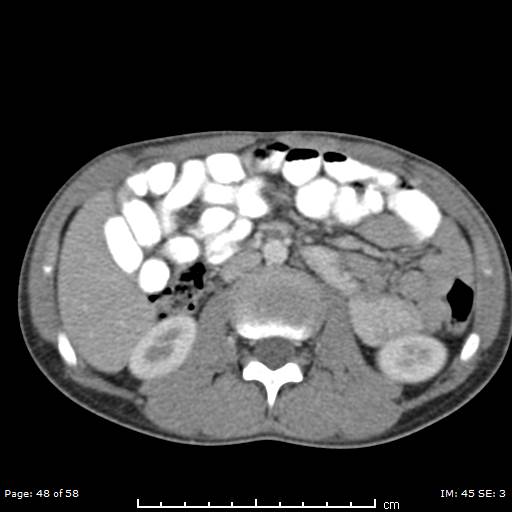 Agenesis of the gallbladder (Radiopaedia 55454-61905 B 48).jpg