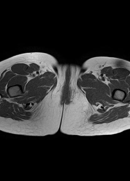 File:Aggressive angiomyxoma of the pelvis and perineum (Radiopaedia 59162-66479 T1 1).jpg