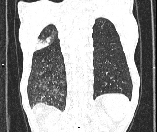 File:Air bronchogram in pneumonia (Radiopaedia 85719-101512 Coronal lung window 51).jpg