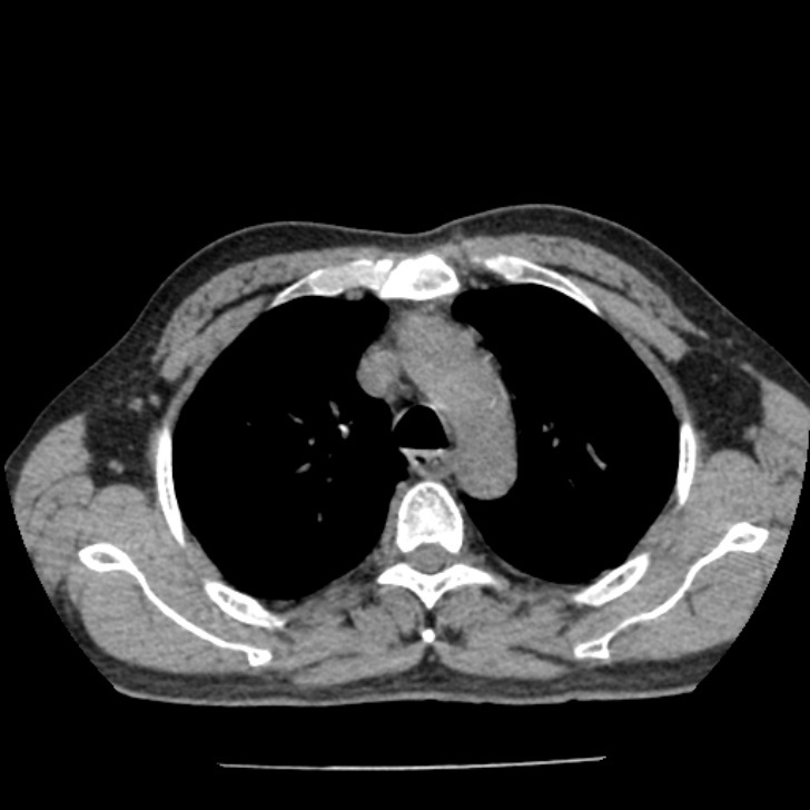Airway foreign body in adult (Radiopaedia 85907-101779 Axial liver window 38).jpg