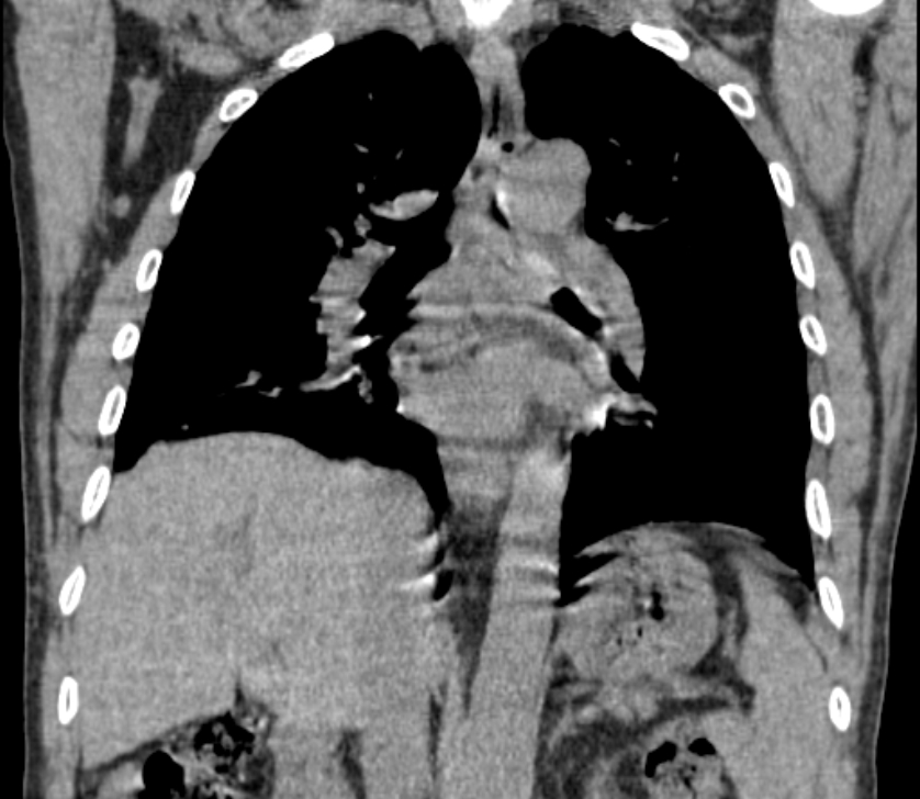 Airway foreign body in adult (Radiopaedia 85907-101779 Coronal liver window 157).jpg