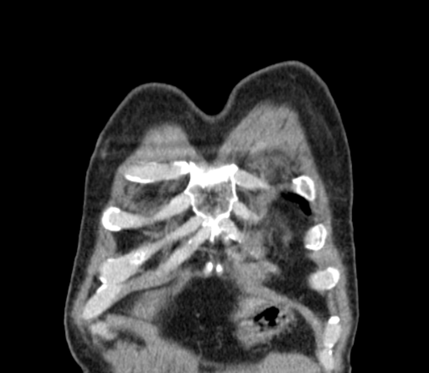 Airway foreign body in adult (Radiopaedia 85907-101779 Coronal liver window 9).jpg