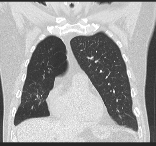 Allergic bronchopulmonary aspergillosis (Radiopaedia 44760-48571 Coronal lung window 19).png