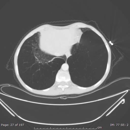 Alpha-1-antitrypsin deficiency (Radiopaedia 50561-55987 Axial lung window 12).jpg