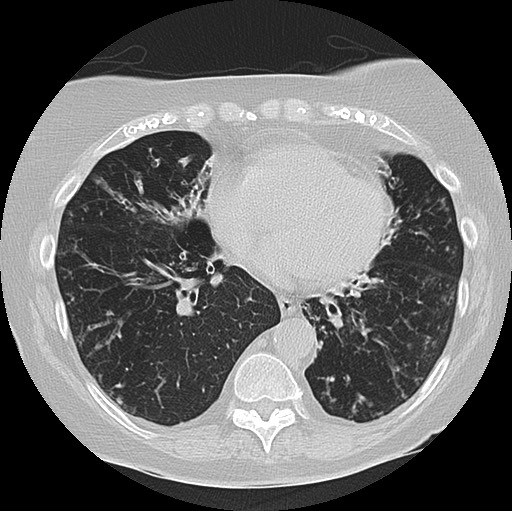 Alpha-1-antitrypsin deficiency (Radiopaedia 72058-82557 Axial lung window 47).jpg